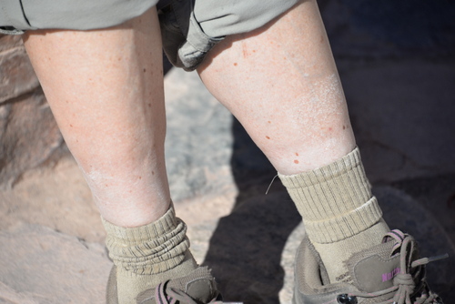 Terry demonstrates the concentration of salt on her leg resulting from her leg dip.