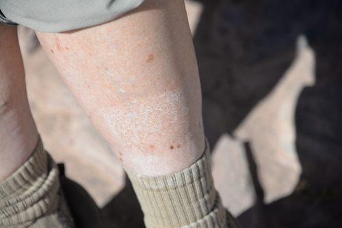 Terry demonstrates the concentration of salt on her leg resulting from her leg dip.