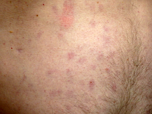 Later that evening, getting ready for dinner, we noticed a few welts on Dennis, the in-front tandem Captain during the pre-noon Hail Storm.